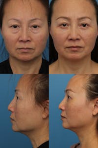 Lower Blepharoplasty Photo Gallery Before & After Gallery - Patient 144460231 - Image 1