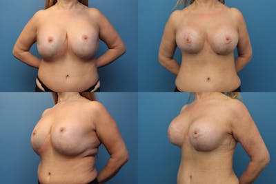 Breast Revision Surgery Before & After Gallery - Patient 144486716 - Image 1
