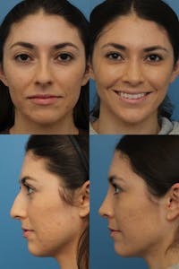 Female Bulbous Tip Before & After Gallery - Patient 144712829 - Image 1