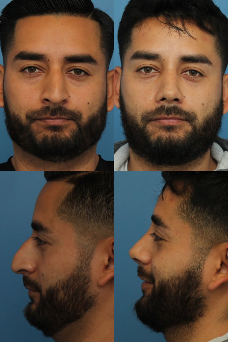 Male Rhinoplasty Before & After Gallery - Patient 144712830 - Image 1