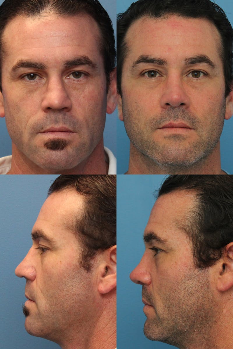 Male Rhinoplasty Before & After Gallery - Patient 146343825 - Image 1