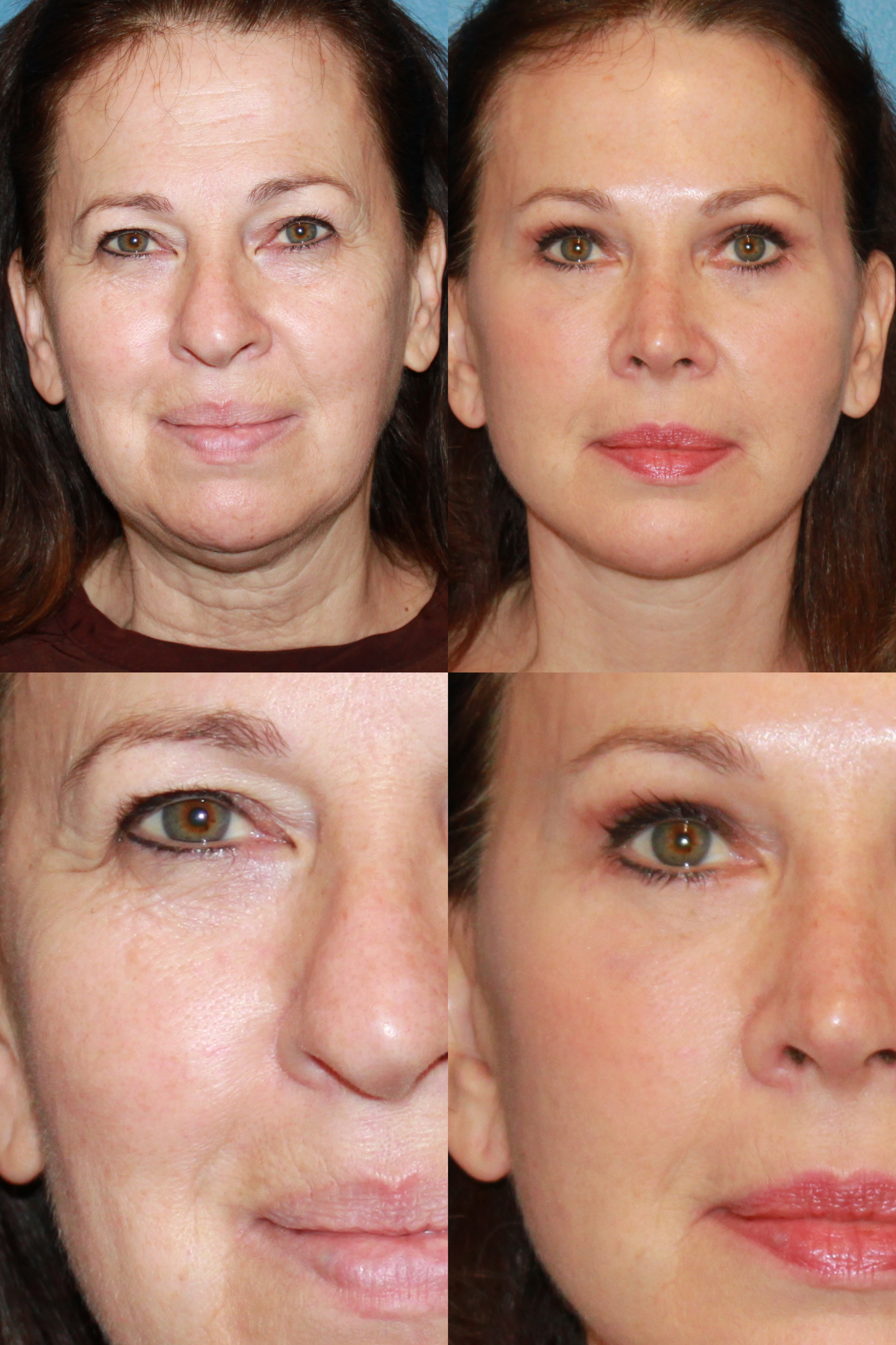 instant Verplicht streepje Brow Lift Before and After | Ranch & Coast Plastic Surgery