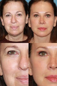 Brow Lift Before & After Gallery - Patient 146166227 - Image 1