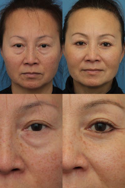 Lower Blepharoplasty Photo Gallery Before & After Gallery - Patient 146416003 - Image 1