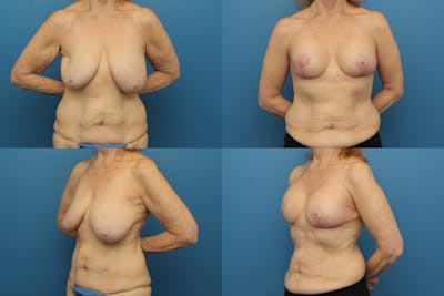 Reductive Augmentation of the Breast Before & After Gallery - Patient 146416143 - Image 1