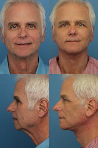 Face Lift Before & After Gallery - Patient 147035358 - Image 1
