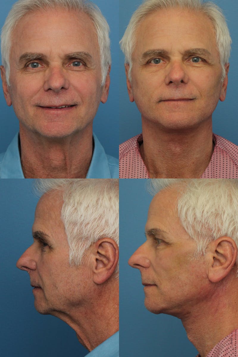 Face Lift Before & After Gallery - Patient 147035358 - Image 1