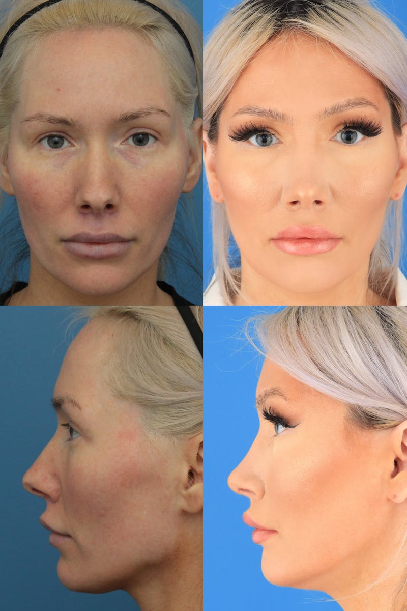 Female Rhinoplasty Before & After Gallery - Patient 147035368 - Image 1