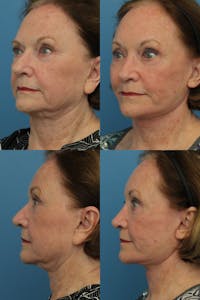 Face Lift Before & After Gallery - Patient 147773319 - Image 1
