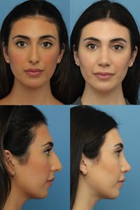 Dr. Francis Rhinoplasty Before & After Gallery - Patient 148588745 - Image 1