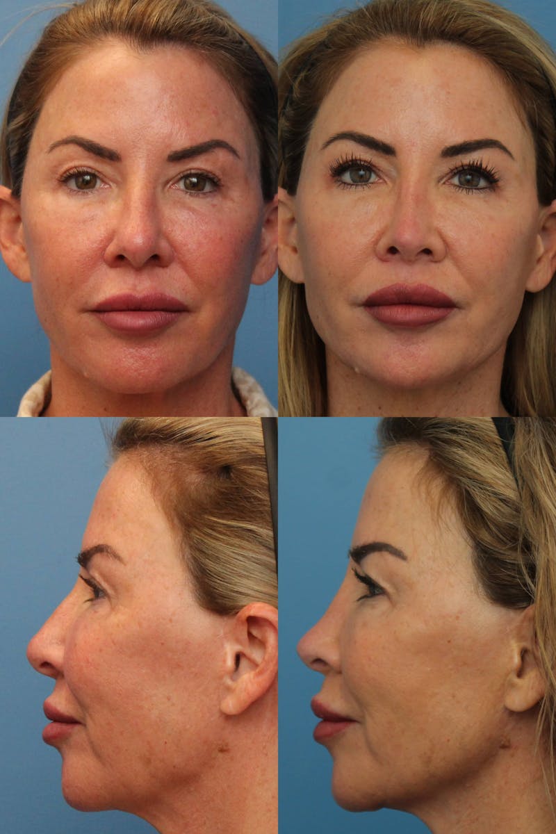 Dr. Francis Rhinoplasty Before & After Gallery - Patient 156740586 - Image 1