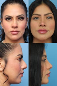 Dr. Francis Rhinoplasty Before & After Gallery - Patient 156740584 - Image 1