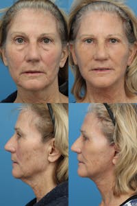 Dr. Francis Facelift Before & After Gallery - Patient 148588793 - Image 1