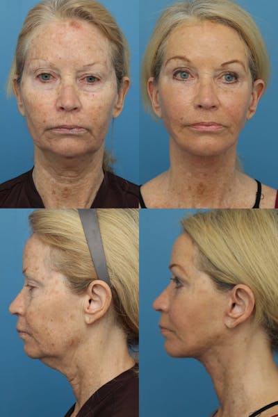 Dr. Francis Facelift Before & After Gallery - Patient 156740360 - Image 1