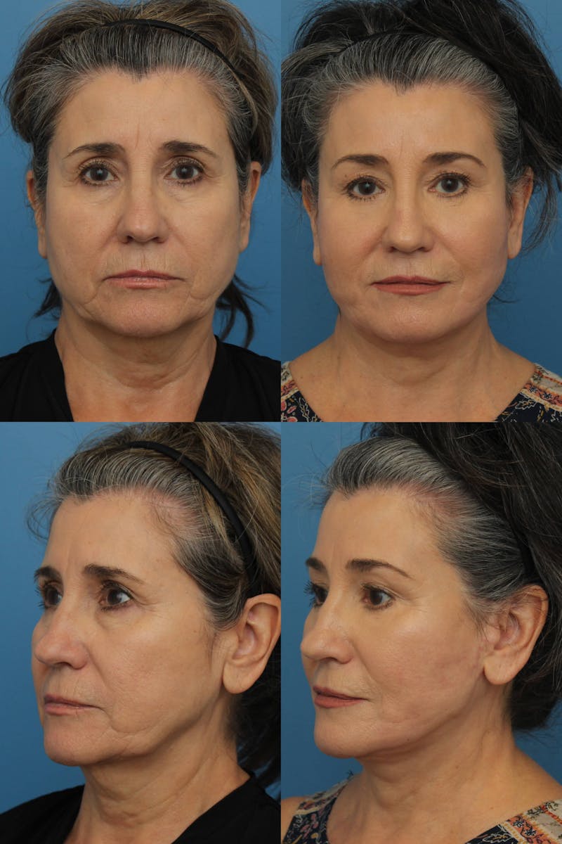 Dr. Francis Facelift Before & After Gallery - Patient 156740362 - Image 1