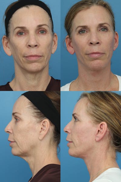 Facelift Before and After  Ranch & Coast Plastic Surgery