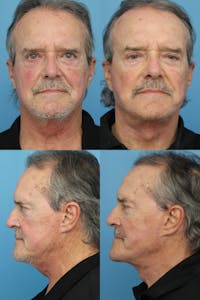 Dr. Francis Facelift Before & After Gallery - Patient 148588798 - Image 1