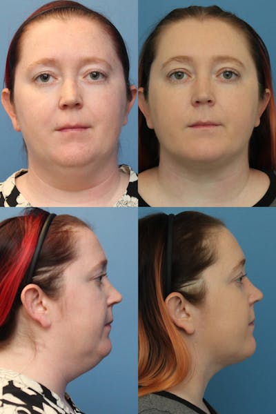 Dr. Francis Submental Liposuction Before & After Gallery - Patient 156740444 - Image 1