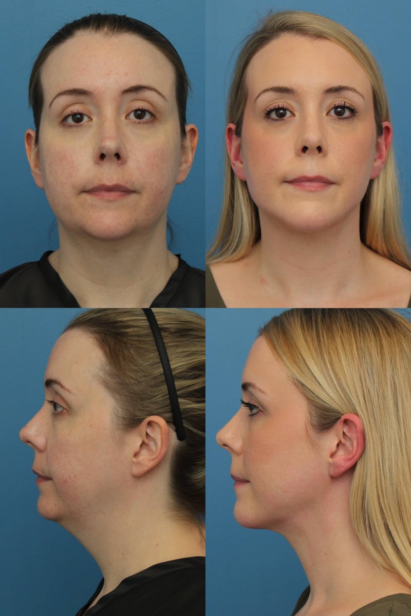 Dr. Francis Submental Liposuction Before & After Gallery - Patient 156740436 - Image 1