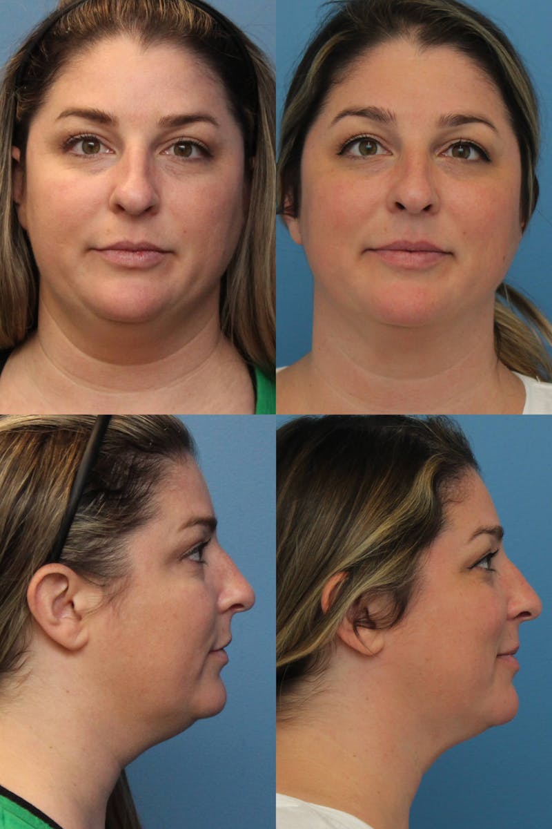 Dr. Francis Submental Liposuction Before & After Gallery - Patient 156740446 - Image 1