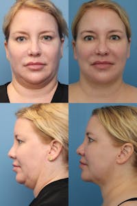 Dr. Francis Submental Liposuction Before & After Gallery - Patient 156740441 - Image 1