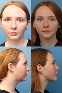 Dr. Francis Submental Liposuction Before & After Gallery - Patient 156740439 - Image 1