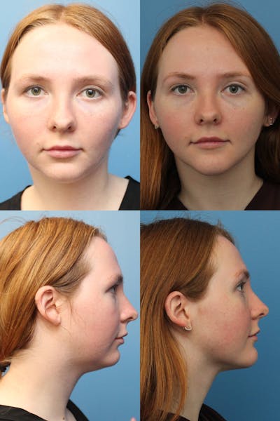 Dr. Francis Submental Liposuction Before & After Gallery - Patient 156740439 - Image 1