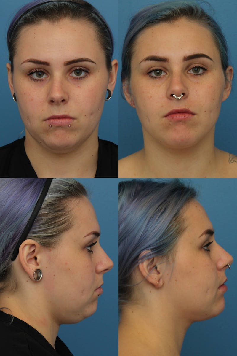 Dr. Francis Submental Liposuction Before & After Gallery - Patient 156740440 - Image 1