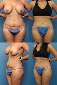 Dr. Francis Tummy Tuck Before & After Gallery - Patient 148588825 - Image 1