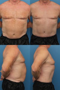 Dr. Francis Tummy Tuck Before & After Gallery - Patient 148588828 - Image 1