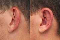Dr. Francis Otoplasty Before & After Gallery - Patient 148701387 - Image 1