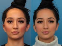 Dr. Francis Otoplasty Before & After Gallery - Patient 148701386 - Image 1