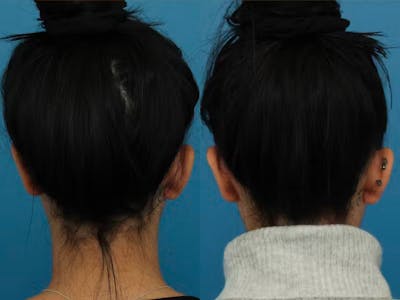 Dr. Francis Otoplasty Before & After Gallery - Patient 148701385 - Image 1