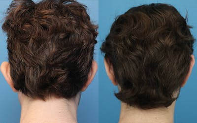 Dr. Francis Otoplasty Before & After Gallery - Patient 148701572 - Image 1