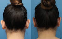 Dr. Francis Otoplasty Before & After Gallery - Patient 148701640 - Image 1