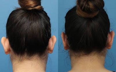 Dr. Francis Otoplasty Before & After Gallery - Patient 148701640 - Image 1