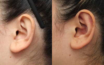 Dr. Francis Otoplasty Before & After Gallery - Patient 148701641 - Image 1