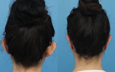 Dr. Francis Otoplasty Before & After Gallery - Patient 148701675 - Image 1