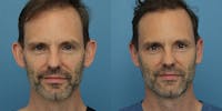 Dr. Francis Otoplasty Before & After Gallery - Patient 148588718 - Image 1