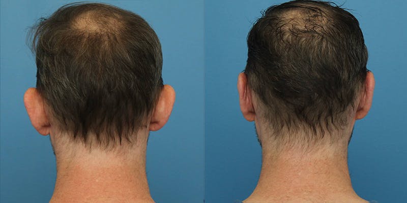 Dr. Francis Otoplasty Before & After Gallery - Patient 148702820 - Image 1