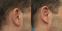 Dr. Francis Otoplasty Before & After Gallery - Patient 148702821 - Image 1