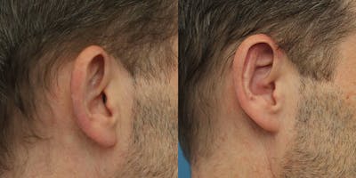 Dr. Francis Otoplasty Before & After Gallery - Patient 148702821 - Image 1