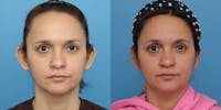 Dr. Francis Otoplasty Before & After Gallery - Patient 148588720 - Image 1
