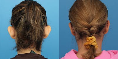 Dr. Francis Otoplasty Before & After Gallery - Patient 148702840 - Image 1