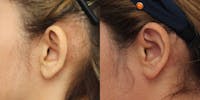 Dr. Francis Otoplasty Before & After Gallery - Patient 148702841 - Image 1