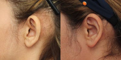 Dr. Francis Otoplasty Before & After Gallery - Patient 148702841 - Image 1