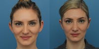 Dr. Francis Otoplasty Before & After Gallery - Patient 148702886 - Image 1