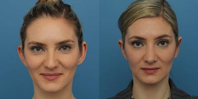 Dr. Francis Otoplasty Before & After Gallery - Patient 148702886 - Image 1