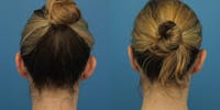 Dr. Francis Otoplasty Before & After Gallery - Patient 148702887 - Image 1