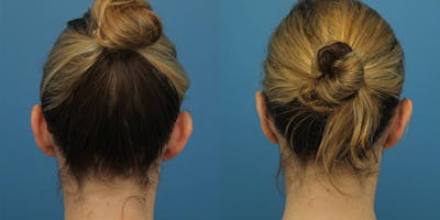 Dr. Francis Otoplasty Before & After Gallery - Patient 148702887 - Image 1